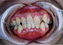 歯周内科写真１