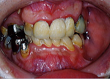歯周病・歯槽膿漏写真