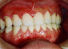 歯周病の原因菌写真